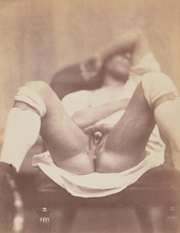 1800's photo of an intersex person laying on back with bottom half of the body exposed. Shows a penile clitoris and vagina.